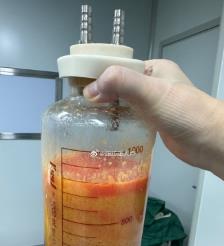 德阳水动力吸脂手术要做多久？